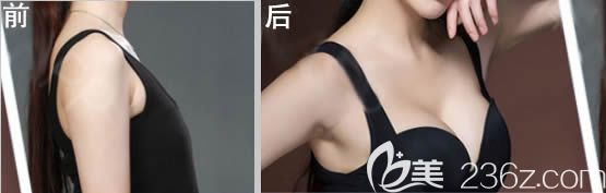 福州美贝尔赵栋材假体隆胸前后对比效果 福州美贝尔赵栋材假体隆胸前后对比效果