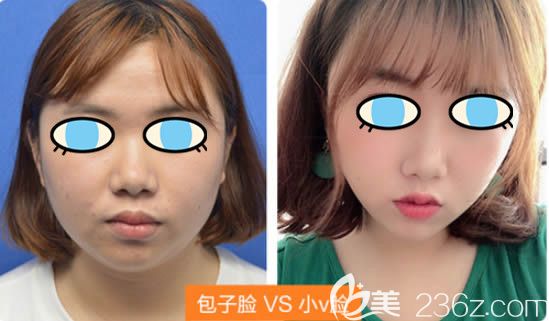 福州美贝尔<!--<i data=20240703-sp></i>-->面部吸脂对比效果图 福州美贝尔<!--<i data=20240703-sp></i>-->面部吸脂对比效果图