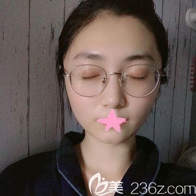 武汉壹加壹王政祥主任面部线雕提升术后4天效果图 武汉壹加壹王政祥主任面部线雕提升术后4天效果图