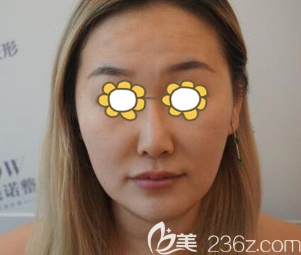 做线雕术前照 做线雕术前照