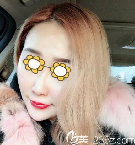 面部埋线提升术后30天效果 面部埋线提升术后30天效果