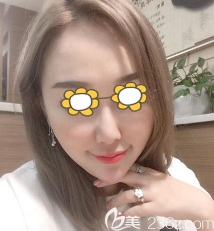 面部埋线提升术后60天效果 面部埋线提升术后60天效果