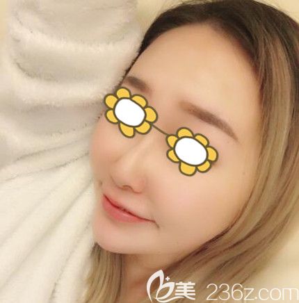 做埋线提升术后90天效果 做埋线提升术后90天效果