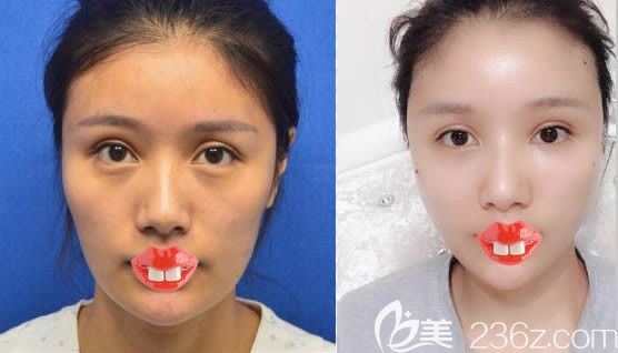 美贝尔赵主任全脸自体脂肪填充前后对比效果 美贝尔赵主任全脸自体脂肪填充前后对比效果