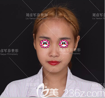 在北京沃尔医疗美容诊所做肋软骨隆鼻前样子 在北京沃尔医疗美容诊所做肋软骨隆鼻前样子