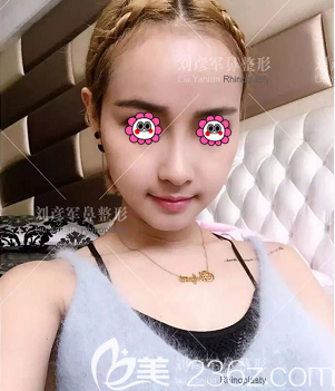 在北京沃尔整形做肋软骨鼻综合第14天<span style= 在北京沃尔整形做肋软骨鼻综合第14天<span style=