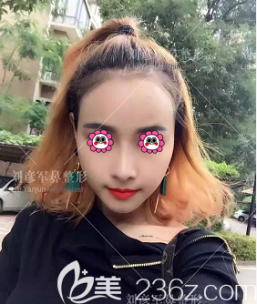 北京沃尔医疗美容肋软骨鼻综合<span style= 北京沃尔医疗美容肋软骨鼻综合<span style=