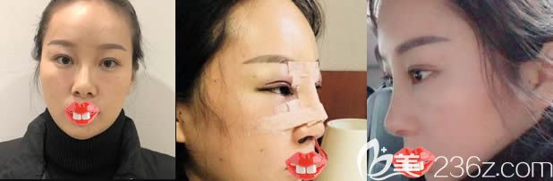 福州美贝尔赵栋材肋软骨隆鼻前后对比照 福州美贝尔赵栋材肋软骨隆鼻前后对比照