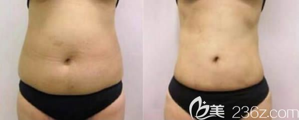 赵栋材医生腰腹吸脂前后对比案例 赵栋材医生腰腹吸脂前后对比案例