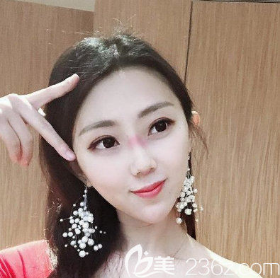 佛山佳丽隆鼻7天拆线了