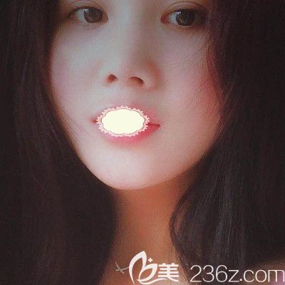 武汉壹加壹医疗整形美容医院王政祥医生瘦脸除皱瘦脸术前照 武汉壹加壹医疗整形美容医院王政祥医生瘦脸除皱瘦脸术前照