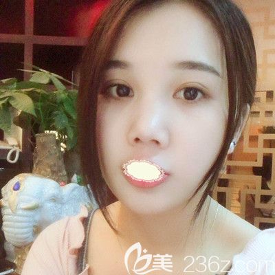 武汉壹加壹王政祥医生瘦脸术后0天效果 武汉壹加壹王政祥医生瘦脸术后0天效果