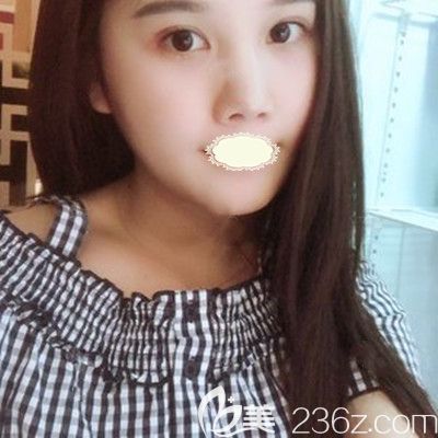 武汉壹加壹王政祥医生瘦脸术后7天案例照 武汉壹加壹王政祥医生瘦脸术后7天案例照