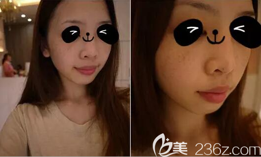 光子祛斑治疗前照片