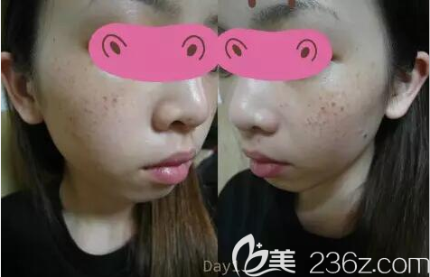 光子祛斑后脸上结痂