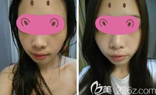 广元美华光子祛雀斑治疗后效果对比