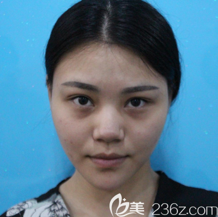 术前塌鼻照片 术前塌鼻照片