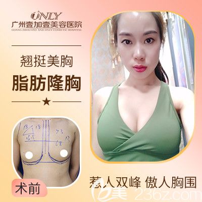 广州壹加壹张红艳隆胸<span style=