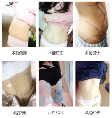 广州军美肖强吸脂<span style=