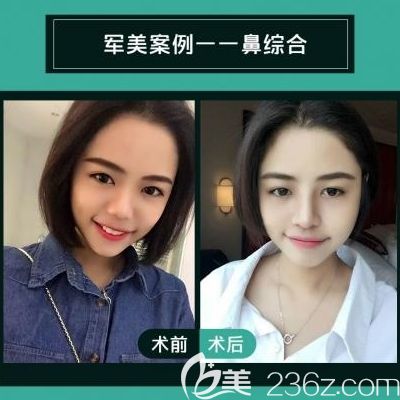 广州军美王世虎隆鼻<span style=