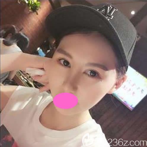 赣州隆鼻哪里好?看我找赣州亚韩“金鼻子”金辉做鼻综合手术1-7天的照片