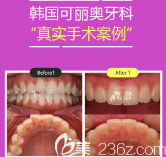 韩国可丽奥牙科医院牙齿隐形矫正案例