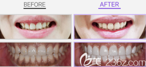 韩国牙贴面哪家医院好？韩国可丽奥案例