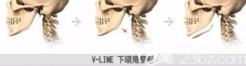 韩国面部轮廓手术