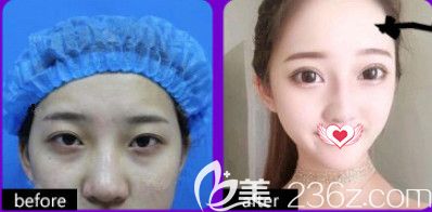 石家庄天伊美双眼皮案例 石家庄天伊美双眼皮案例