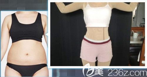 天伊美整形医院做腰腹吸脂案例 天伊美整形医院做腰腹吸脂案例