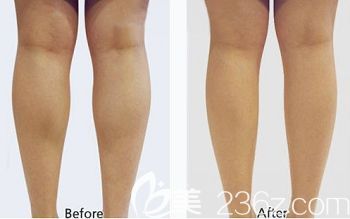 石家庄天伊美注射瘦腿案例 石家庄天伊美注射瘦腿案例