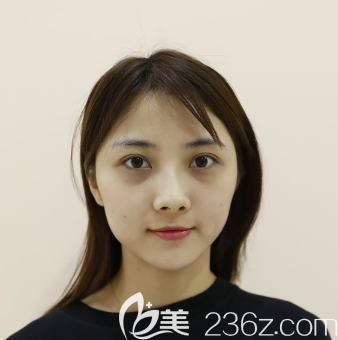 自体脂肪全脸填充术前照 自体脂肪全脸填充术前照