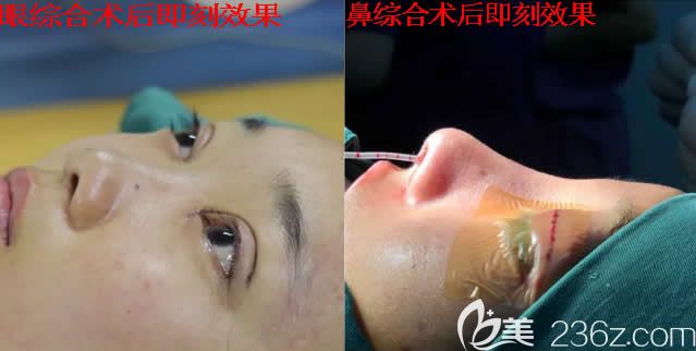 我在北海韩美整形做鼻综合和眼综合术后即刻效果