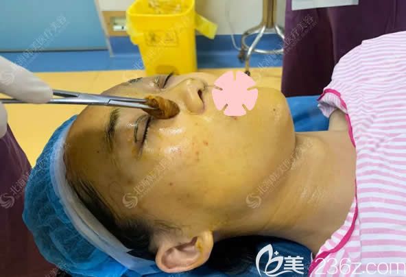 北海韩美整形医生在给我做眼鼻整形术前消毒