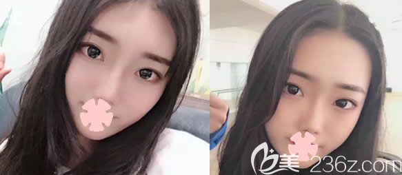 一次性在北海韩美整形做了肋软骨鼻综合隆鼻/全切双眼皮/开内眼角,上传40天恢复图