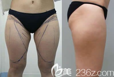 我在北海韩美整形做水动力大腿吸脂前的照片 我在北海韩美整形做水动力大腿吸脂前的照片