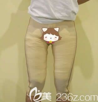 我在北海韩美做大腿水动力环形吸脂第5天 我在北海韩美做大腿水动力环形吸脂第5天