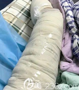 我在北海韩美做大腿环形吸脂当天照片 我在北海韩美做大腿环形吸脂当天照片