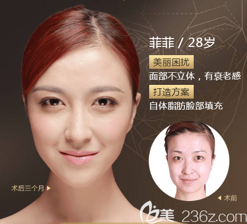 找广州美莱<!--<i data=20240703-sp></i>-->做的脂肪填充消肿很快 找广州美莱<!--<i data=20240703-sp></i>-->做的脂肪填充消肿很快