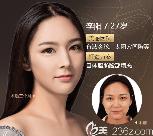 广州美莱<!--<i data=20240703-sp></i>-->面部脂肪填充案例 广州美莱<!--<i data=20240703-sp></i>-->面部脂肪填充案例