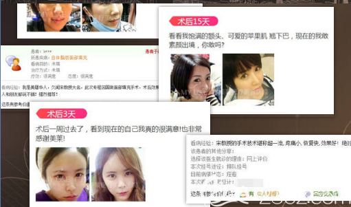 爱美者对<!--<i data=20240703-sp></i>-->做的脂肪填充术后真实评价 爱美者对<!--<i data=20240703-sp></i>-->做的脂肪填充术后真实评价