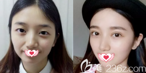 <!--<i data=20240703-sp></i>-->双眼皮手术案例 <!--<i data=20240703-sp></i>-->双眼皮手术案例