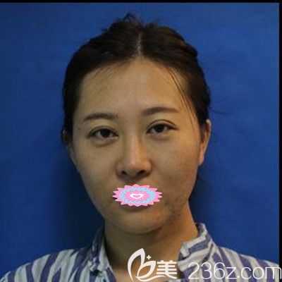 武汉壹加壹医疗整形内容医院李艳东医生自体脂肪面部填充术前照 武汉壹加壹医疗整形内容医院李艳东医生自体脂肪面部填充术前照