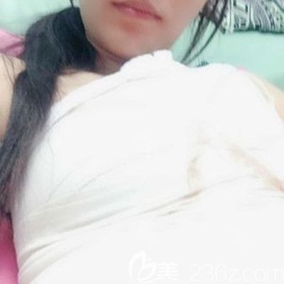 武汉壹加壹付俊俐医生曼托假体隆胸术后7天展示图 武汉壹加壹付俊俐医生曼托假体隆胸术后7天展示图