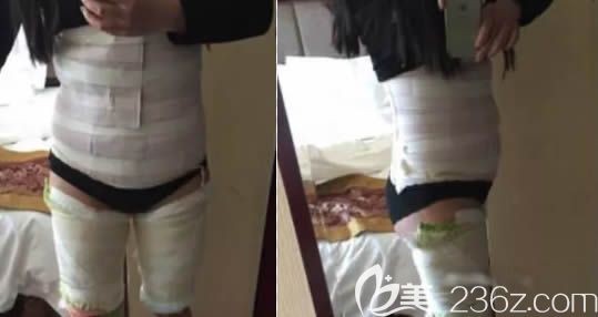 次做完腰腹吸脂后的照片 次做完腰腹吸脂后的照片
