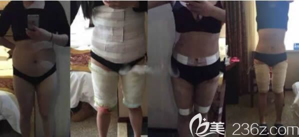 做吸脂前和第1、6个月的变化过程图 做吸脂前和第1、6个月的变化过程图