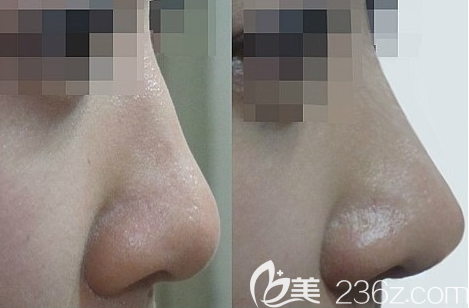 韩国美泊门李在承假体隆鼻综合整形案例前后效果对比图