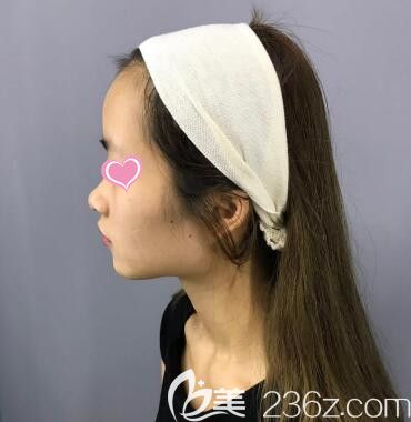 在斯美诺做鼻综合术前照 在斯美诺做鼻综合术前照