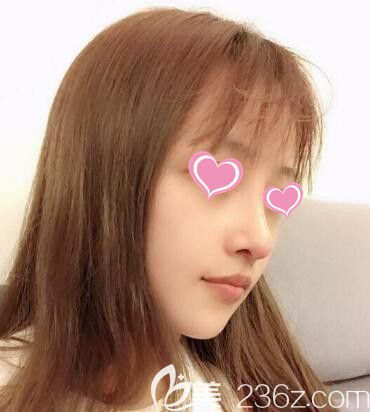 做鼻综合整形术后30天效果 做鼻综合整形术后30天效果