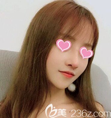 做鼻综合整形术后60天时恢复效果 做鼻综合整形术后60天时恢复效果